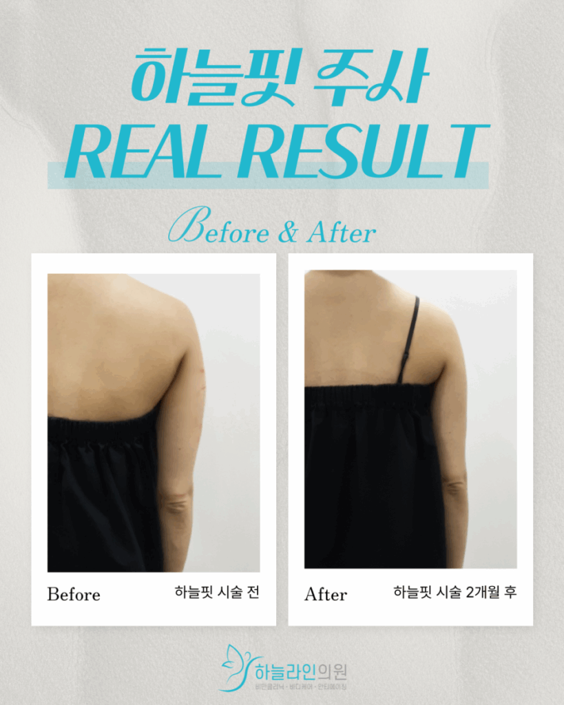 하늘핏 팔뚝 지방추출주사 시술 전.후