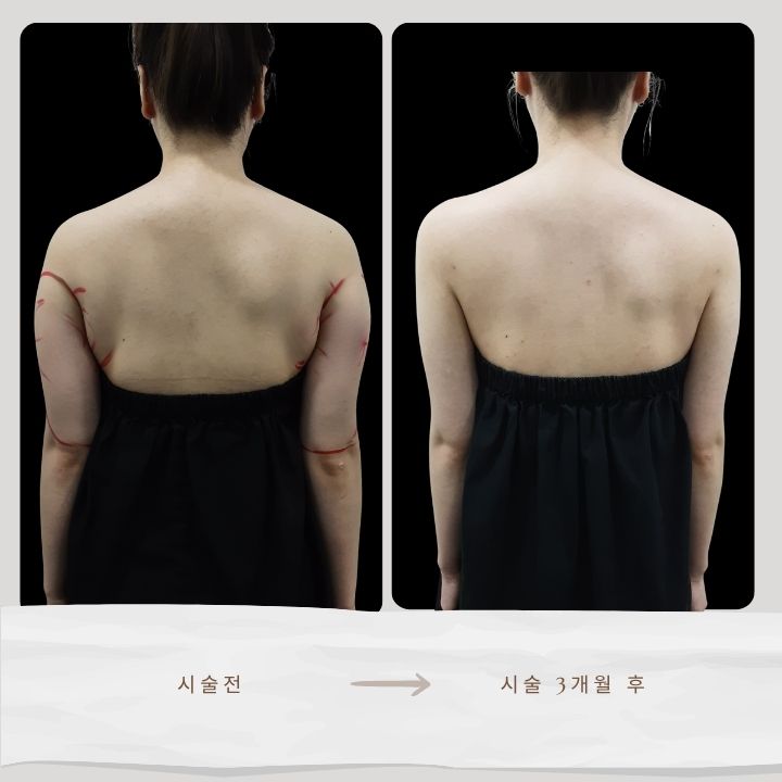 지방추출주사의 전과 후