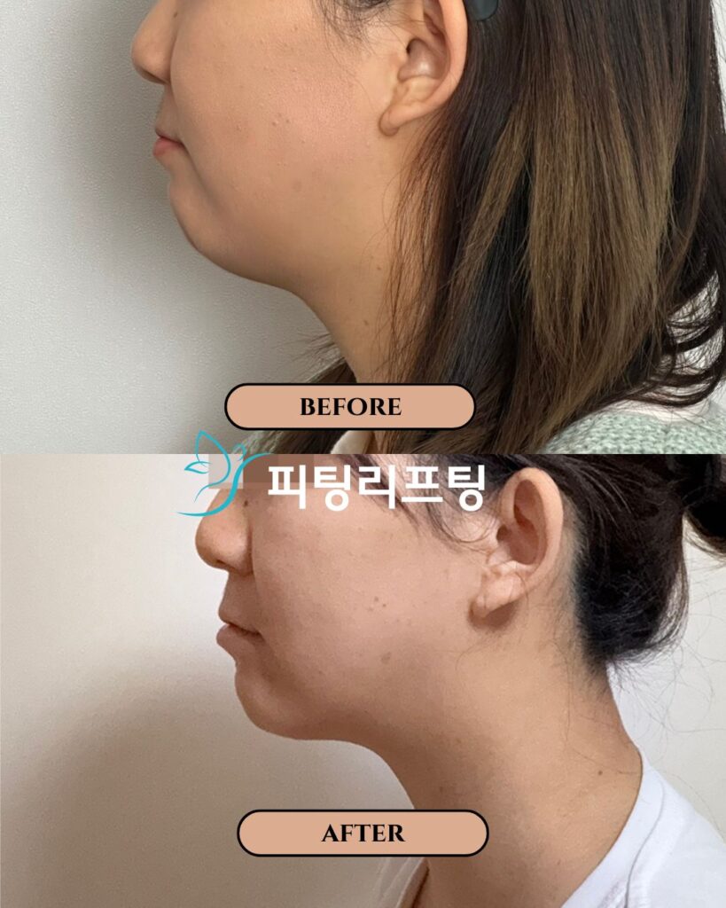 피팅리프팅