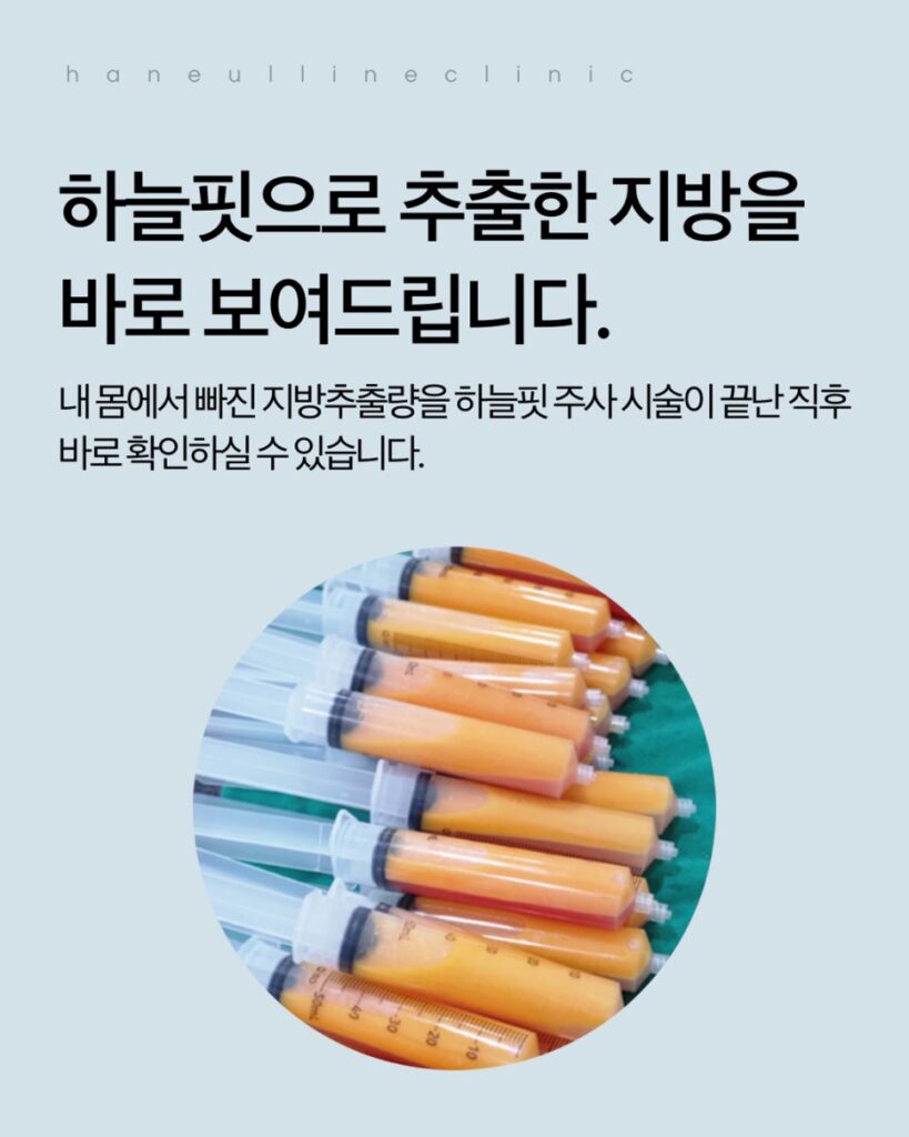 지방추출주사 시술로 추출한 지방모습