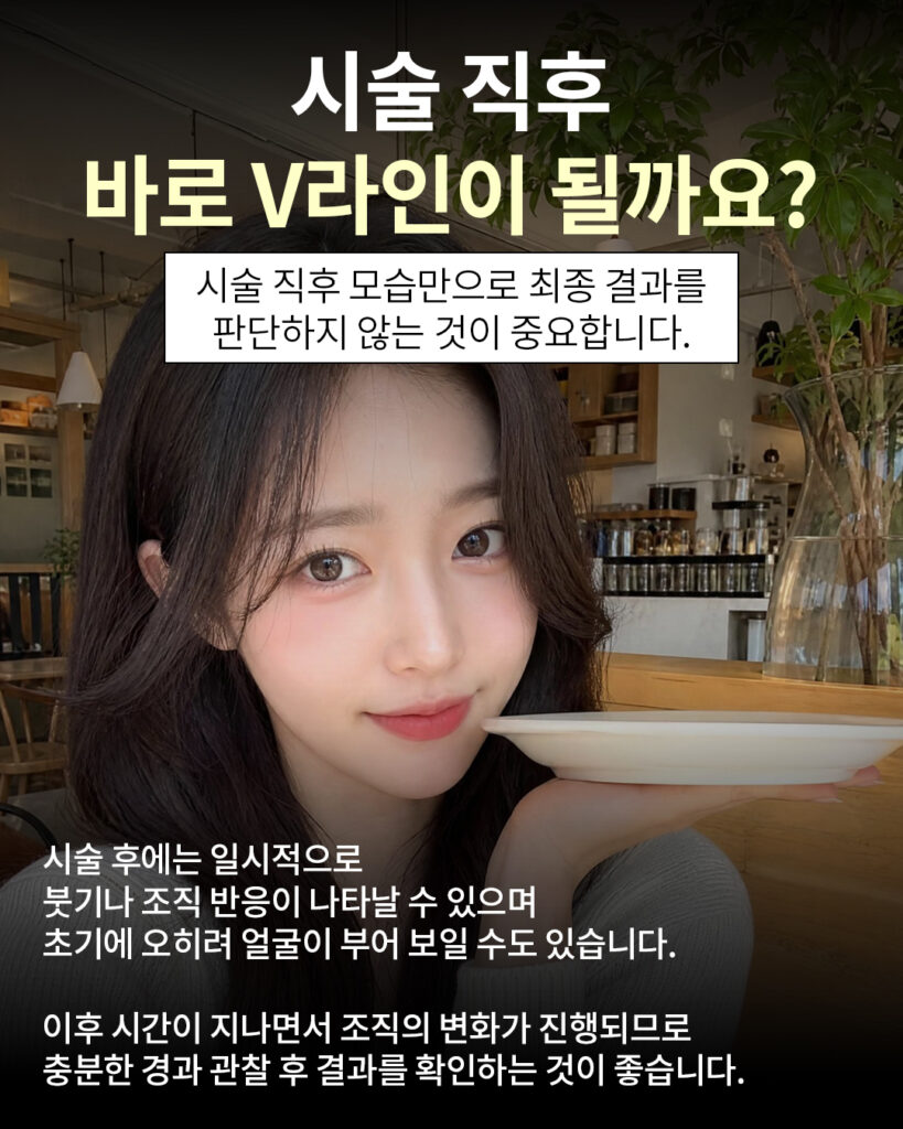턱라인 윤곽주사 브이핏 시술 직후 상태