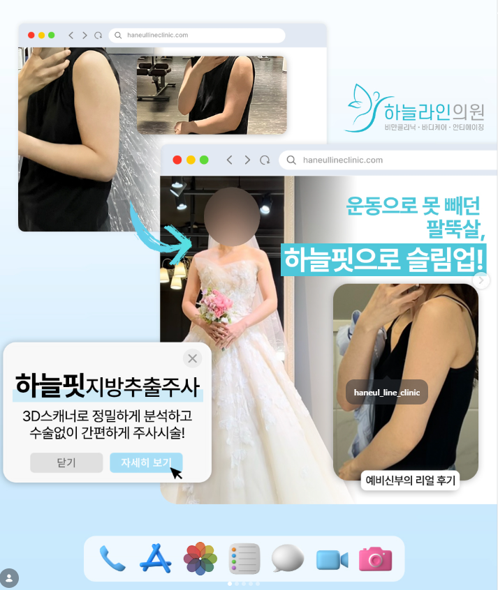 팔뚝지방추출주사 후기